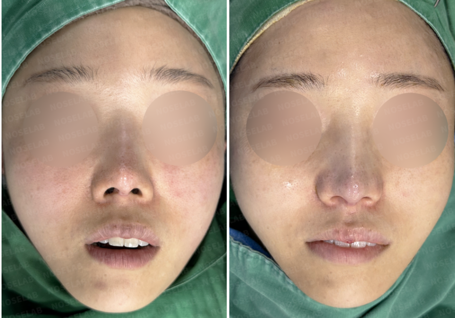 Before and after images of upturned nose correction – Frontal views before and immediately after closed rhinoplasty Korea showing natural refinement and skin reinforcement.