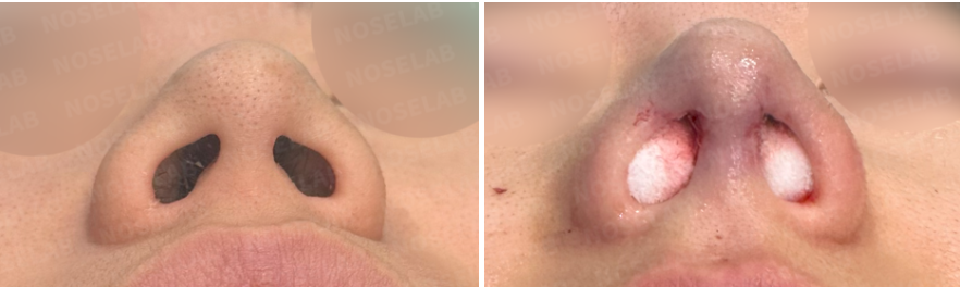 Upturned nose correction Korea before and after surgery – nostril view comparison