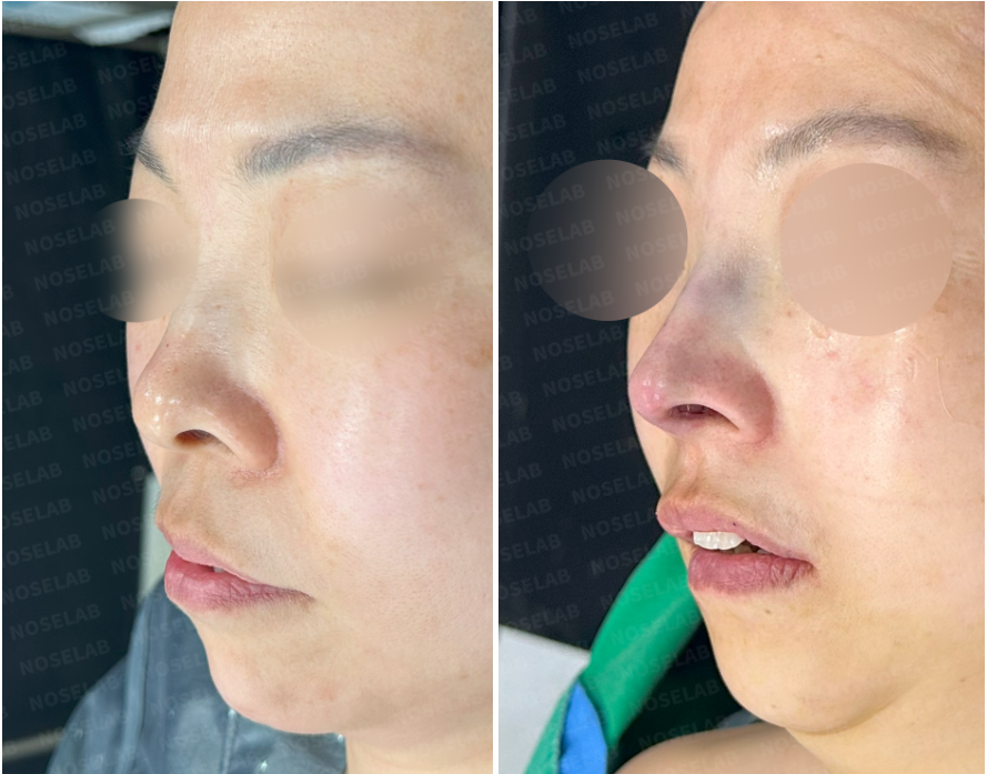 Oblique side view of upturned nose correction – Before surgery (left) and immediately after closed rhinoplasty (right).