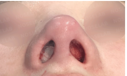 Immediately after no-implant nose surgery using autologous rib cartilage: Nostril view showing improved nostril symmetry and refined nasal tip structure.