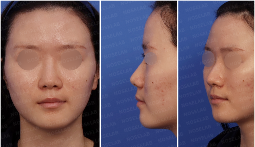Preoperative design consultation images showing frontal view, left oblique side view, and left lateral view of a female patient with a wide nasal bridge and blunt nasal tip.