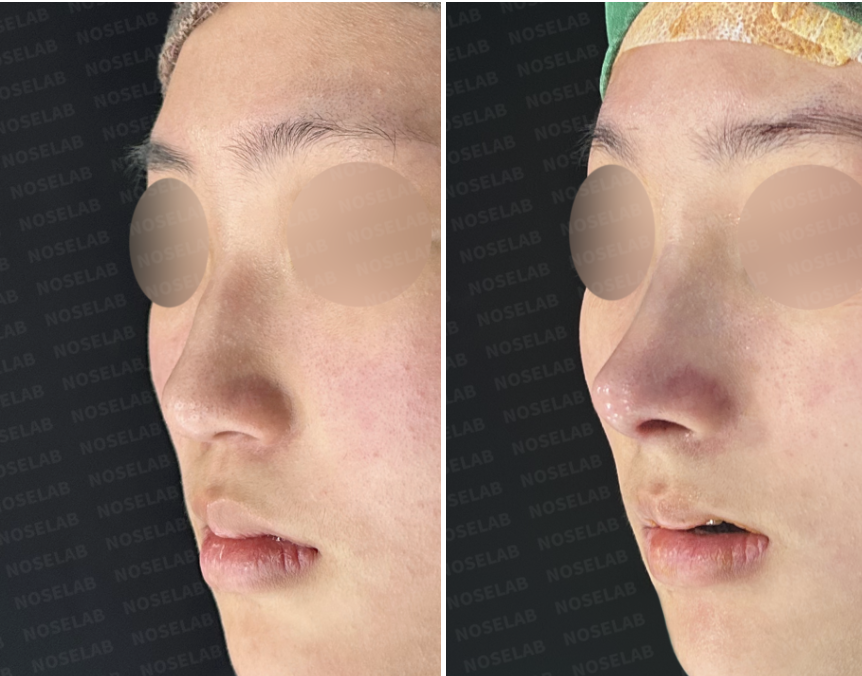 Before and immediately after surgery oblique view showing refined nasal tip projection, correction of dorsal hump, and improved overall nasal contour following closed rhinoplasty with rib cartilage reconstruction and osteotomy.