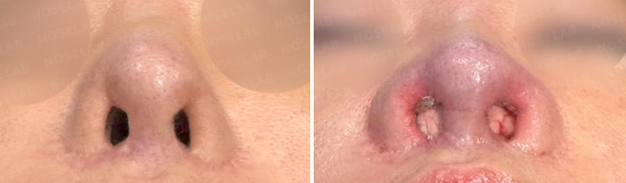 Corrective rhinoplasty after nostril reduction – before surgery (left) and immediate postoperative nostril view (right)