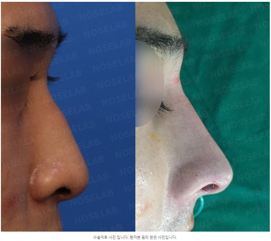 Before and after Closed Rhinoplasty Seoul – correction of deviated and hump nose using self rib cartilage at NoseLab Plastic Surgery.