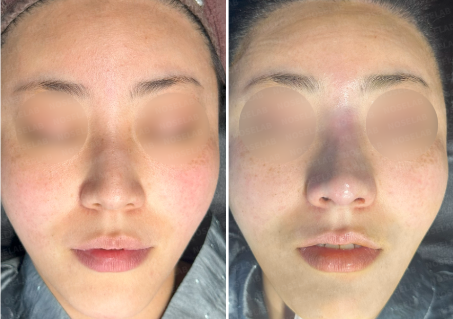 Frontal view before surgery (left) after surgery (right)