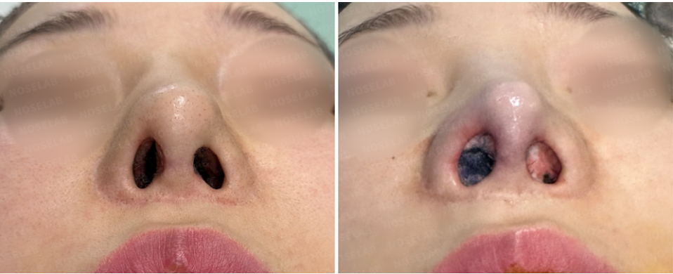 Before surgery (left), after surgery (right) The bluntness of the nose tip was improved, and since there was a lot of scar tissue, it was removed safely and considering that it could reappear once again.