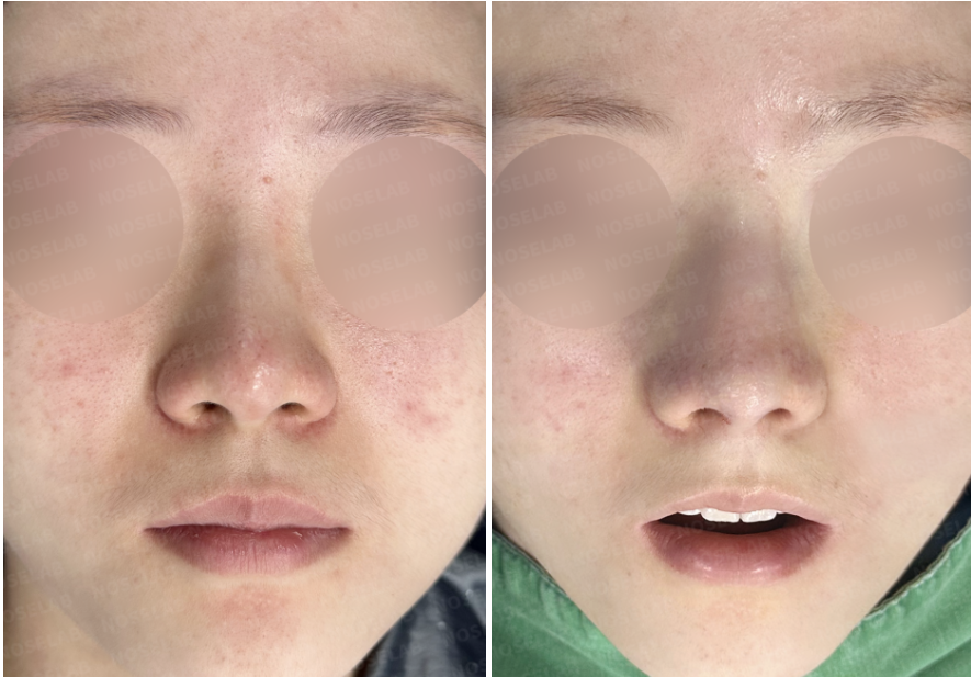 Frontal view comparison showing preoperative nasal appearance on the left and immediate postoperative condition on the right after refinement of the nasal bridge and nasal tip support.