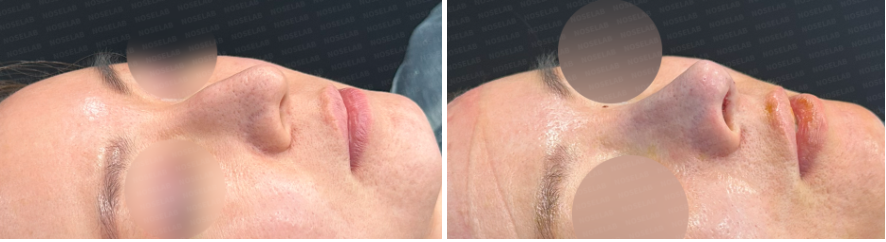 Oblique side view before and immediately after droopy nose and hump correction rhinoplasty – showing smoother bridge and refined nasal tip.