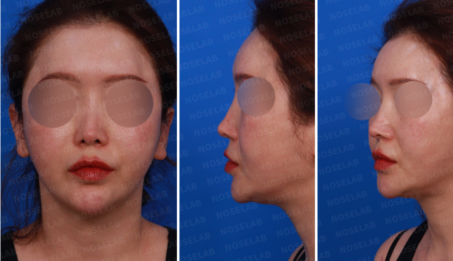 Design consultation images for contracted nose reconstruction: frontal, left profile, and oblique side views showing nasal deviation and structural collapse.