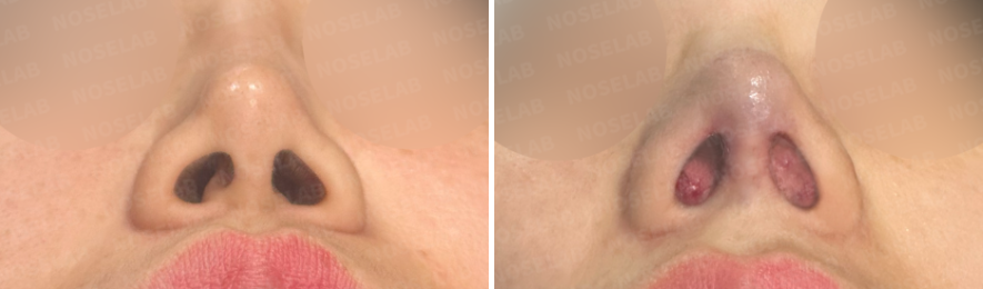 Before and immediately after Medpor removal and septal reconstruction — nostril view showing improved symmetry and restored internal structure.