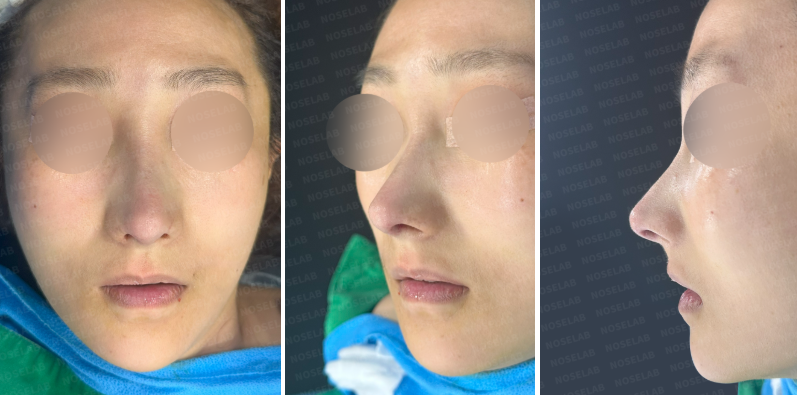 Closed rhinoplasty Korea immediately after surgery – frontal view, right oblique side view, and right side view photos of a patient with corrected long nose, nasal deviation, and facial asymmetry.