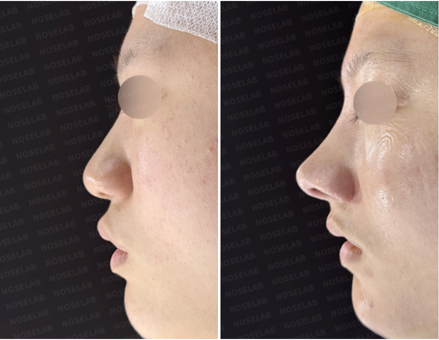 Before and immediately after surgery lateral view showing natural elevation of the nasal tip, improved tip projection, and smoother bridge-to-tip transition following closed rhinoplasty with rib cartilage septal extension.