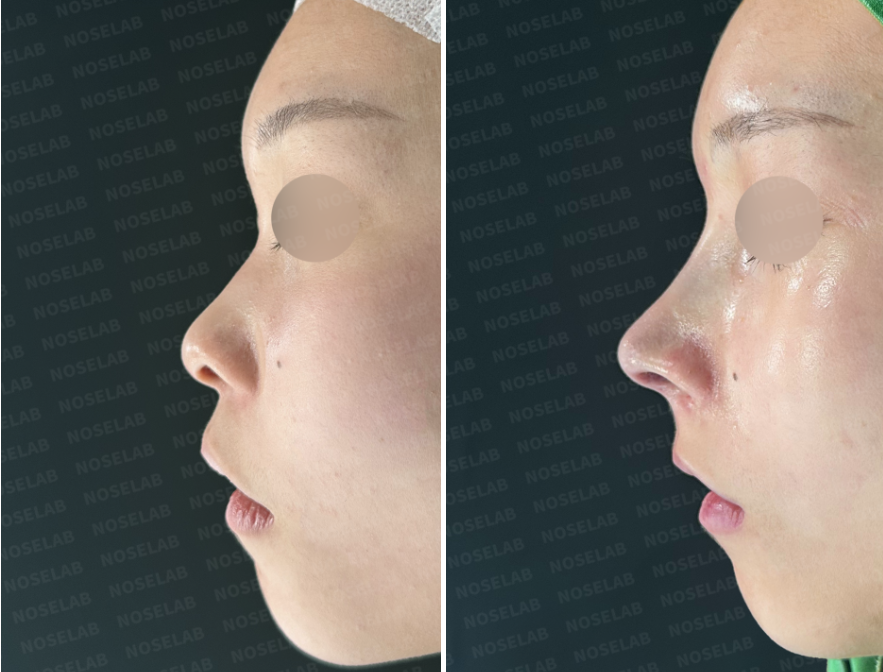 Before and immediately after surgery lateral view showing increased nasal bridge height and improved nasal tip projection following closed rhinoplasty with donor rib cartilage and silicone implant.