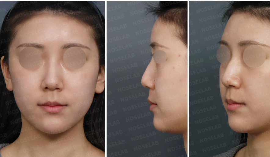 Preoperative consultation images showing frontal view, left lateral view, and left oblique view of a patient with a drooping nasal tip and dorsal hump following previous nasal filler and thread lifting procedures.