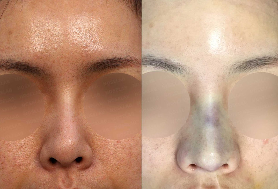 Frontal before and after view showing symmetry improvement after Deviated and Upturned Nose Correction – Closed Rhinoplasty Korea