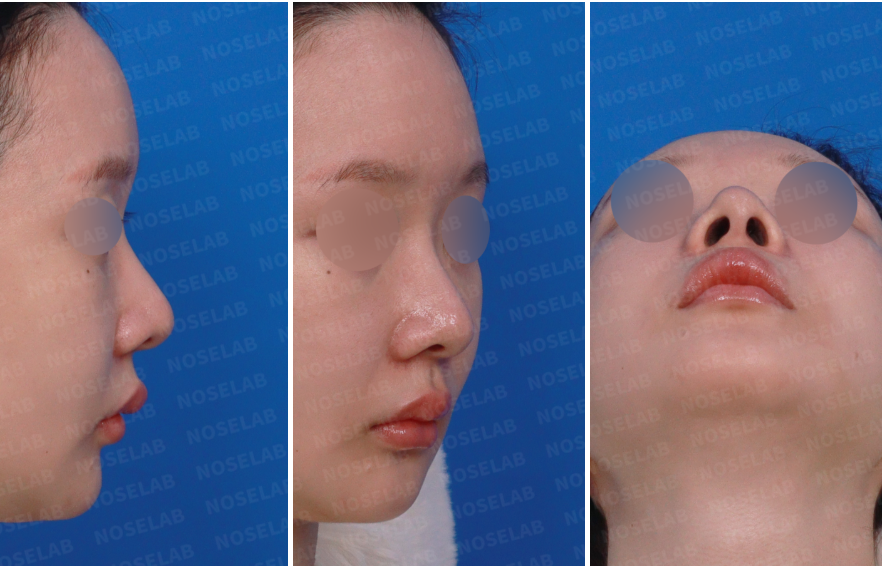 Preoperative design consultation photos showing right side, right oblique, and nostril views in a closed rhinoplasty Korea revision case, used to assess nasal deviation, tip projection, and nostril asymmetry before structural correction.