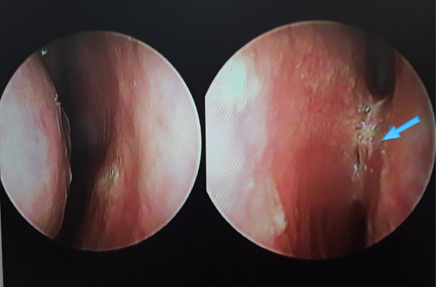 Endoscopic view showing adhesion between the left septal mucosa and inferior turbinate in deviated nose correction.