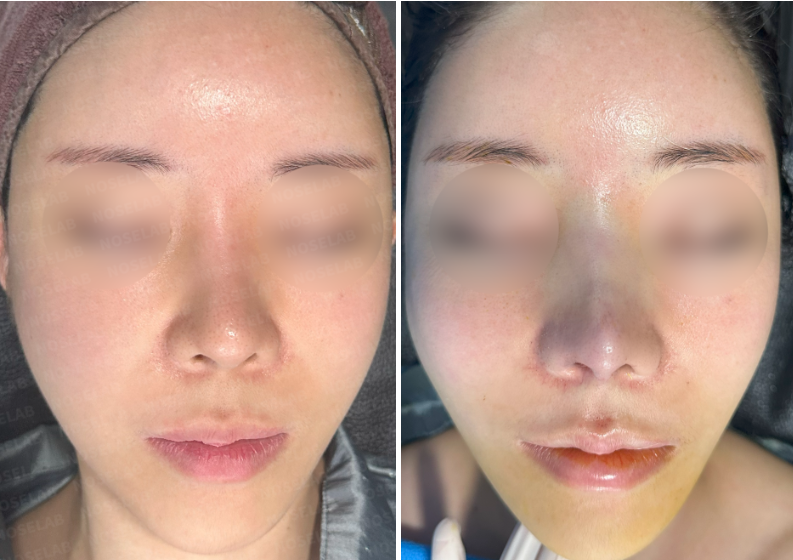 Frontal view before surgery (left) after surgery (right)