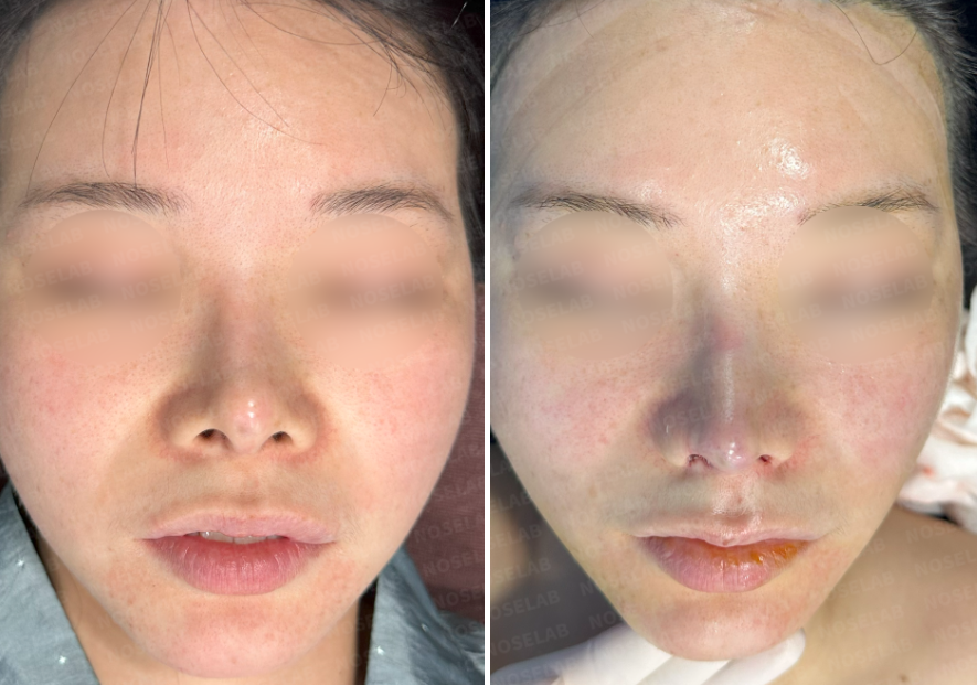 Before-and-after frontal view comparison showing improved nasal alignment, reduced asymmetry, and stabilized nasal tip following revision rhinoplasty.