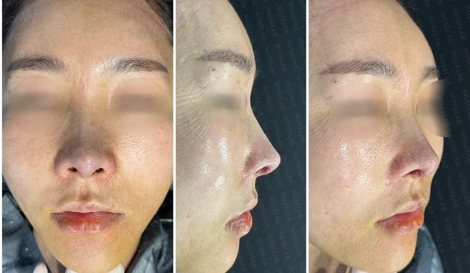 Photos taken immediately after surgery, frontal view, 45-angle view, and side profile.