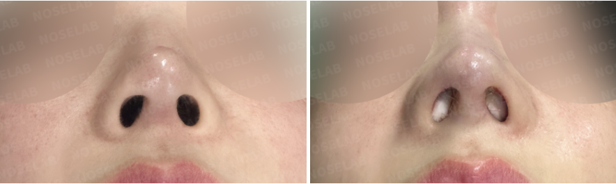 Before and immediately after surgery basal view showing improved nostril symmetry, refined nasal base, and enhanced tip support following revision closed rhinoplasty with rib cartilage and dermal reinforcement.