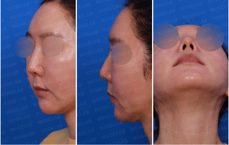 Right side, oblique view, and nostril exposure before revision rhinoplasty – showing nasal tip drooping, residual dorsal hump, and wide nostrils