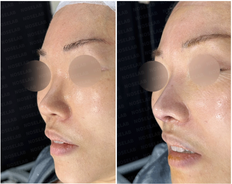 Oblique right side view before surgery (left) and immediately after revision rhinoplasty correcting nasal deformity caused by synthetic dermal graft absorption (right).