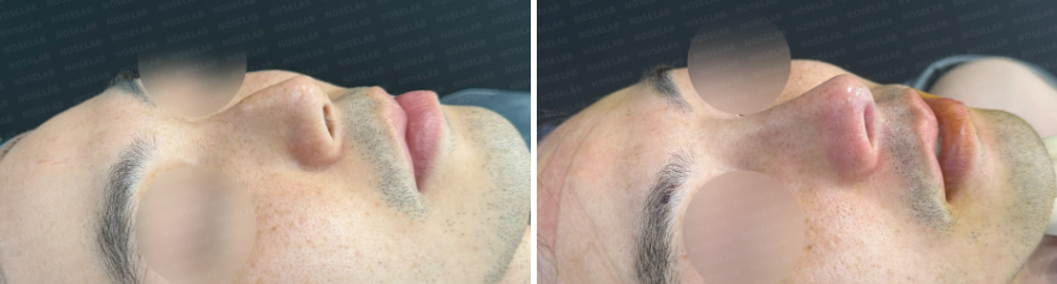 45-degree angle view before surgery (left) after surgery (right)
