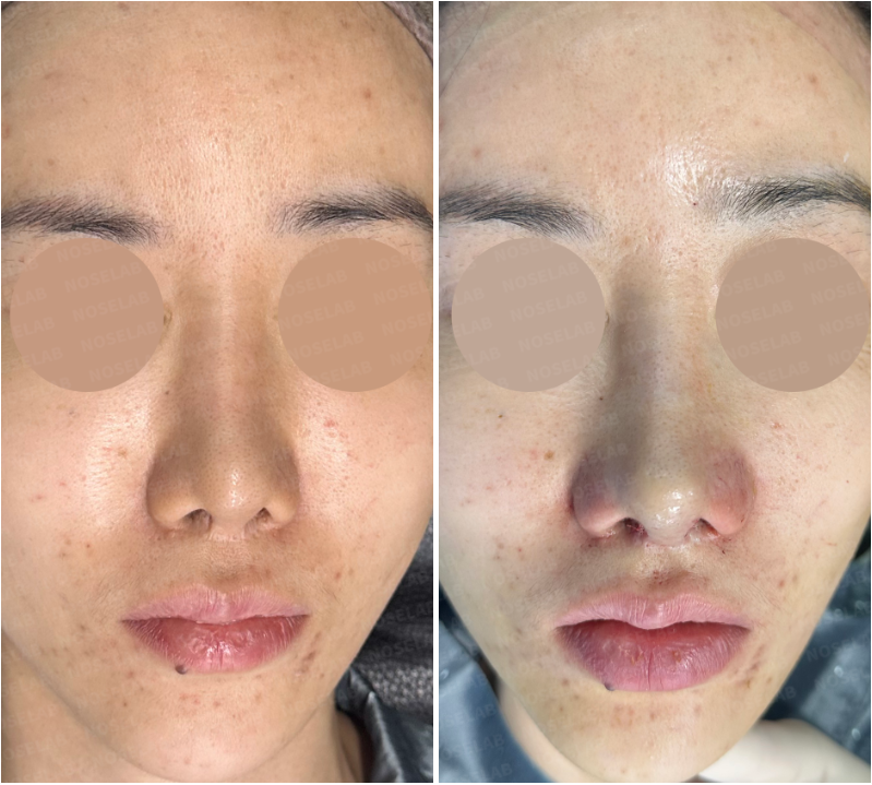 Before surgery (left), after surgery (right)