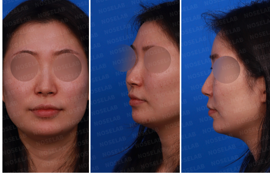 Frontal, left side, and oblique view photos before hump nose correction and deviated nose surgery – Nose Lab Clinic