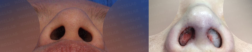 Basal view showing reduced nostril exposure and improved symmetry after Deviated and Upturned Nose Correction – Closed Rhinoplasty Korea