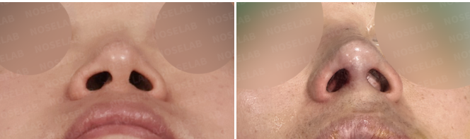 Nostril before and immediately after views showing improved nasal base balance after septal reconstruction and alar depression correction.