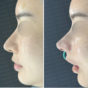 Before and after photos of closed rhinoplasty Korea for crooked nose correction. Side view showing improved nasal profile and natural tip reconstruction.