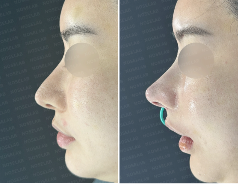 Before and immediately after closed rhinoplasty in Korea. Side view comparison showing correction of pinocchio-like and crooked nose.