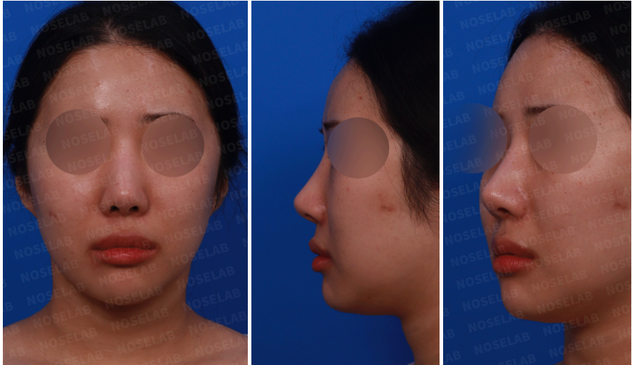 Design consultation photos before customized nasal reconstruction surgery – frontal view, left side view, and oblique side view showing nasal shape and proportion