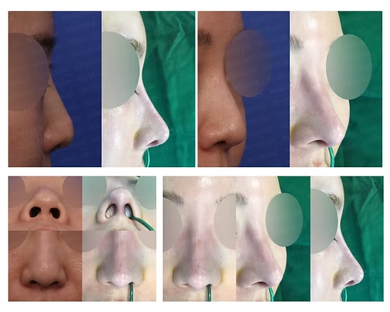 Before and after remove thread rhinoplasty showing correction of bulbous and flat nose with columella lengthening.