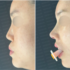 Before and after Medpor removal and septal reconstruction using autologous rib cartilage — side view showing restored nasal structure and improved facial harmony.