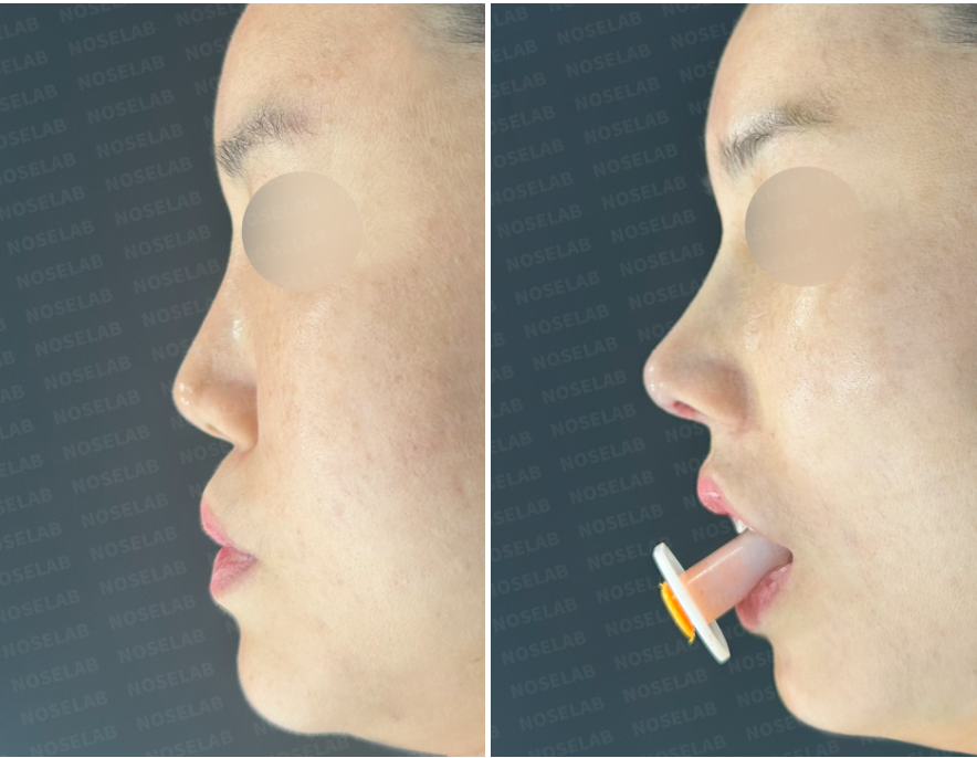 Before and immediately after Medpor removal and rib cartilage reconstruction — side view showing smoother nasal line and improved columellar contour.