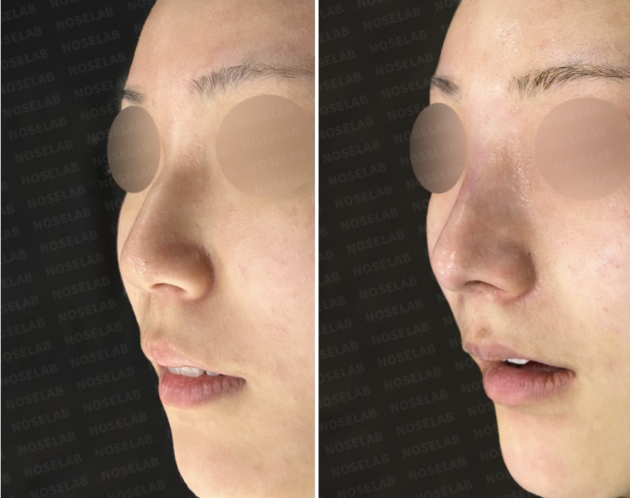 Before and immediately after surgery oblique view showing correction of a dorsal hump and refinement of the nasal tip after nasal filler removal and closed rhinoplasty with autologous rib cartilage.