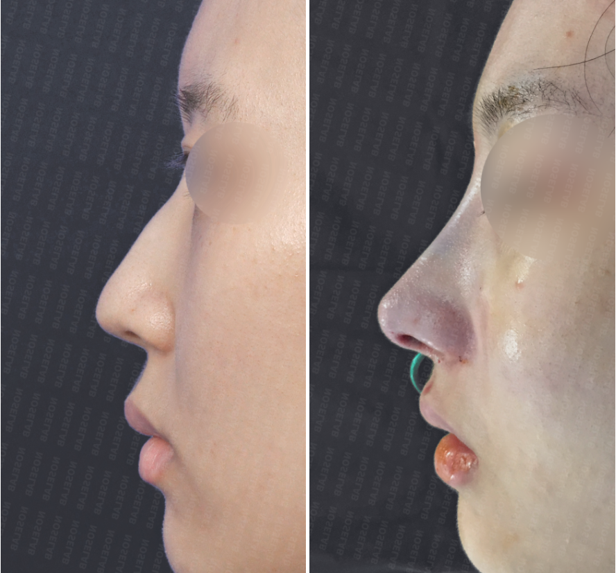 Before and immediately after hump nose correction – left side view photos