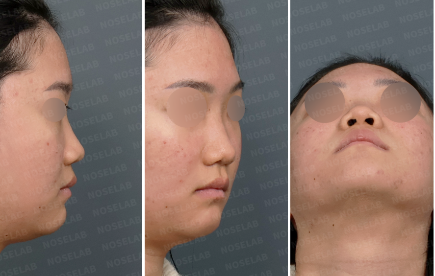 Preoperative design consultation photos showing right side view, right oblique side view, and nostril view of a patient with low nasal bridge, bulbous nasal tip, and retracted columella before structural closed rhinoplasty.