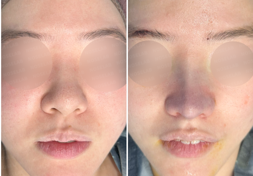 Before and immediately after surgery comparison photo of a patient with bulbous nose and nasal congestion, frontal view, taken at Nose Lab Clinic.