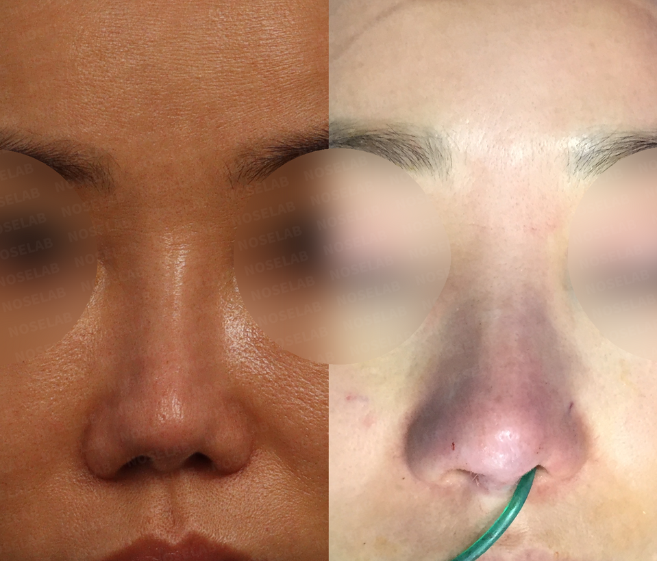 Closed Rhinoplasty Korea Mild Contracted Blunt Nose before and after frontal view – reduced nostril exposure and improved nasal tip definition using self rib cartilage by Dr. Cha-Young Kang, NoseLab Clinic