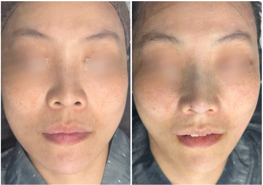 Before and immediately after primary rhinoplasty – frontal view showing natural refinement and improved nasal balance.