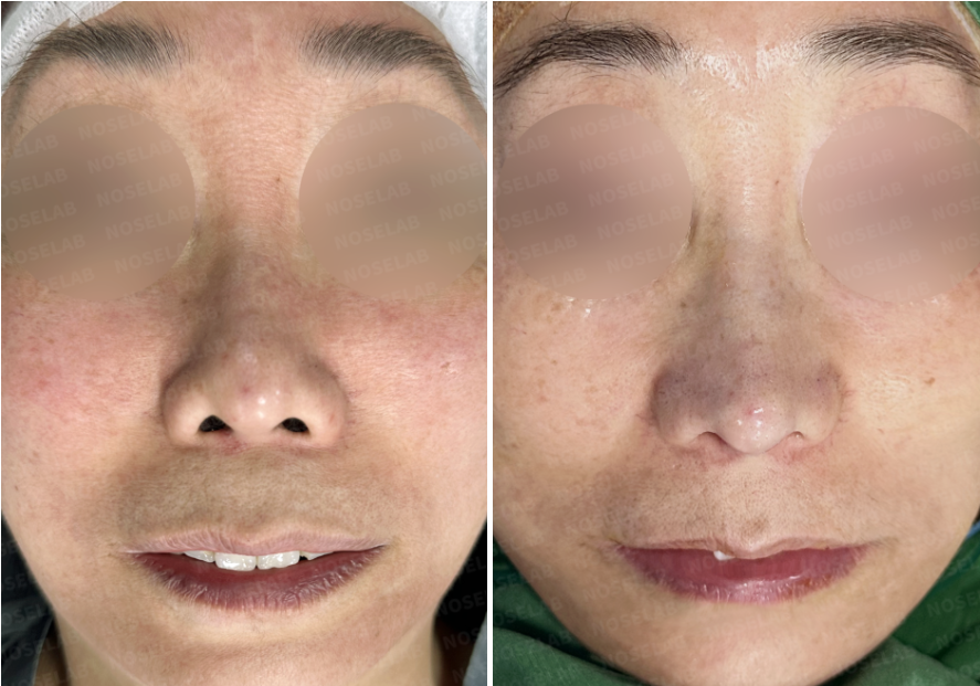 Before and immediately after comparison showing frontal view after closed rhinoplasty Korea, demonstrating improved nasal tip definition, corrected nostril asymmetry, and a more balanced nasal base.