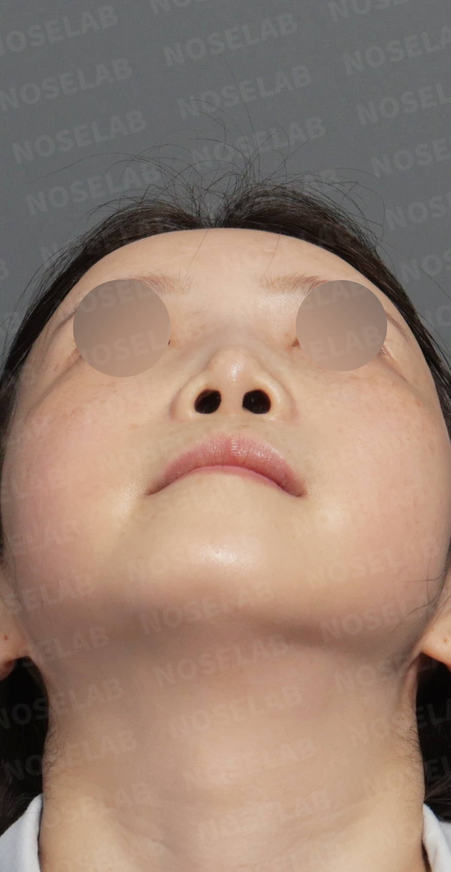 Preoperative consultation: nostril view.