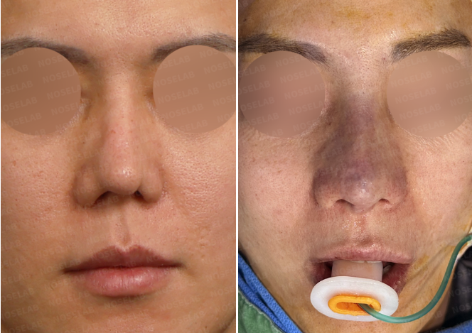 Frontal before and immediately after views showing rib cartilage revision rhinoplasty Korea for contracted nose reconstruction.