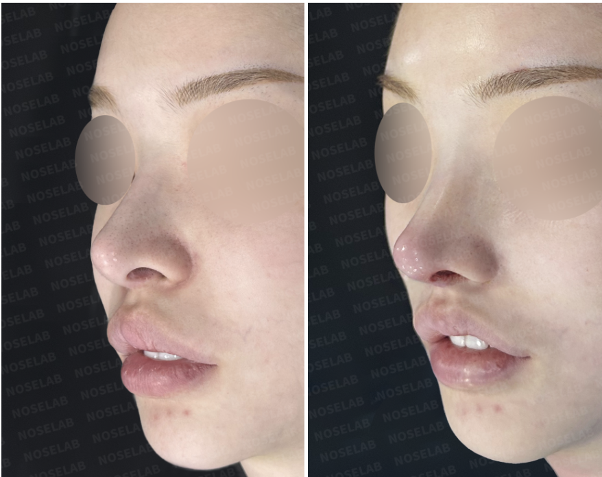Before and immediately after closed rhinoplasty Korea, side profile comparison showing refined nasal bridge height, improved tip projection, corrected nasolabial angle, and a smoother, more balanced nasal contour after structural reconstruction.