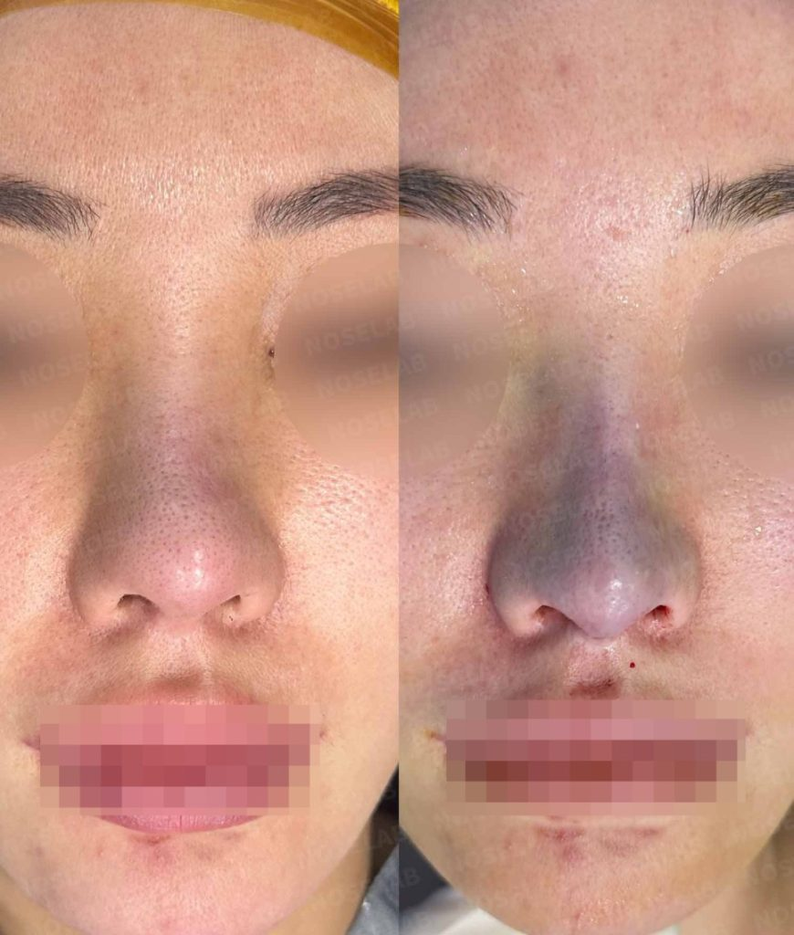 Before and after frontal view – bulbous nose revision using self-rib cartilage through closed rhinoplasty, showing improved nostril symmetry and refined nasal tip (Noselab Clinic)