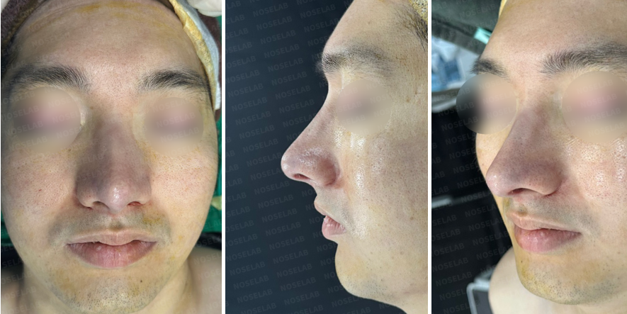 Immediately after dorsal hump reduction and septal reconstruction – frontal, side, and oblique side views showing improved nasal contour and symmetry.